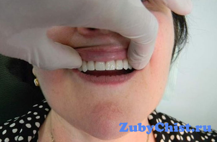 Надежная фиксация протеза