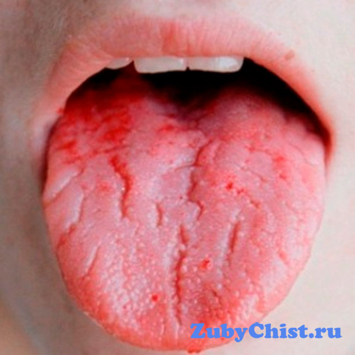 Налет и трещинки на языке