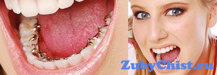 Невидимые брекеты на зубах