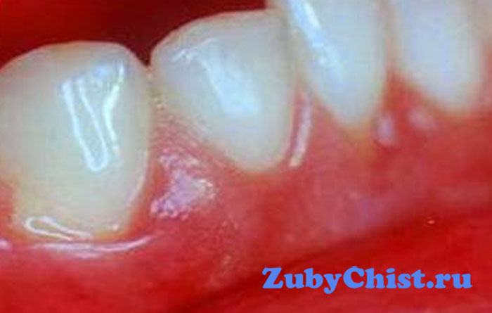 Опухоль десны