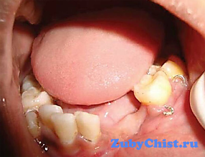 Остеомиелит челюсти