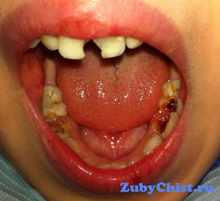 Острая форма периодонтита