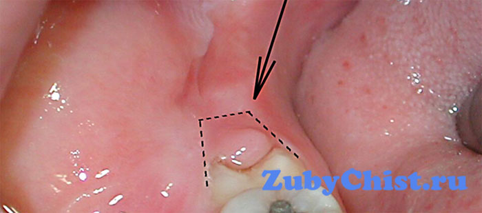 Острая форма перекоронита