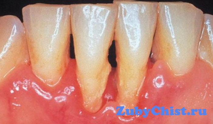 Острая форма заболевания