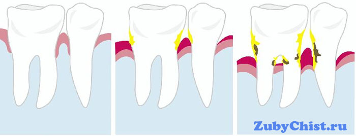 Пародонтит