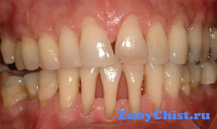 Пародонтоз десны