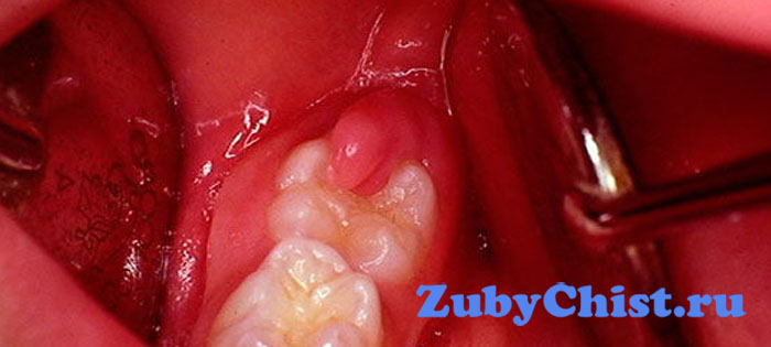 Перикоронит при прорезывании зуба