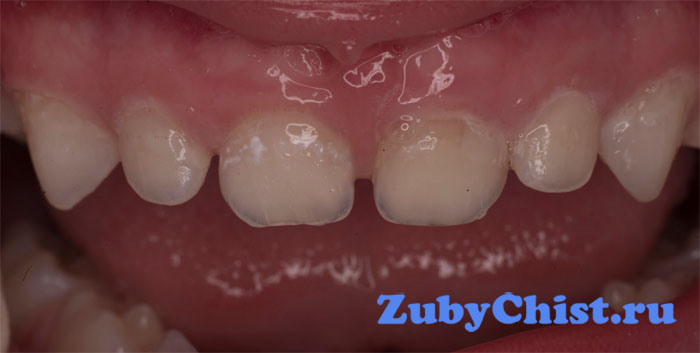 Периодонтит у детей - фото