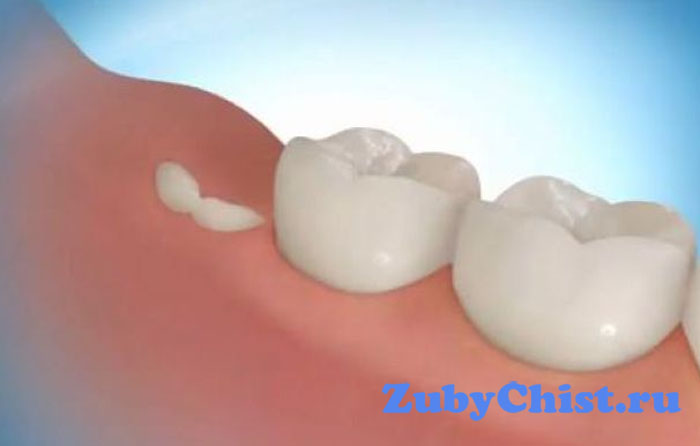 Прорезывание зуба мудрости