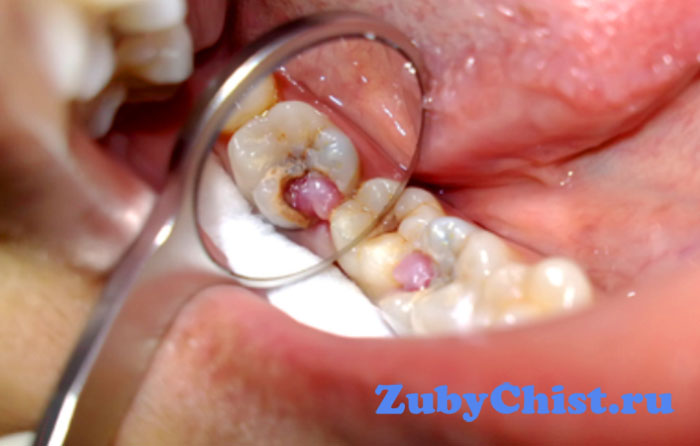 Пульпит зуба