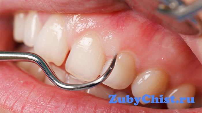 Рак десны наглядно