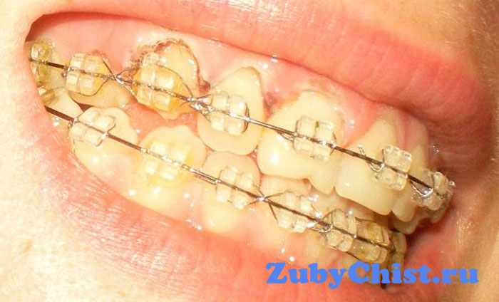 Резекция десны