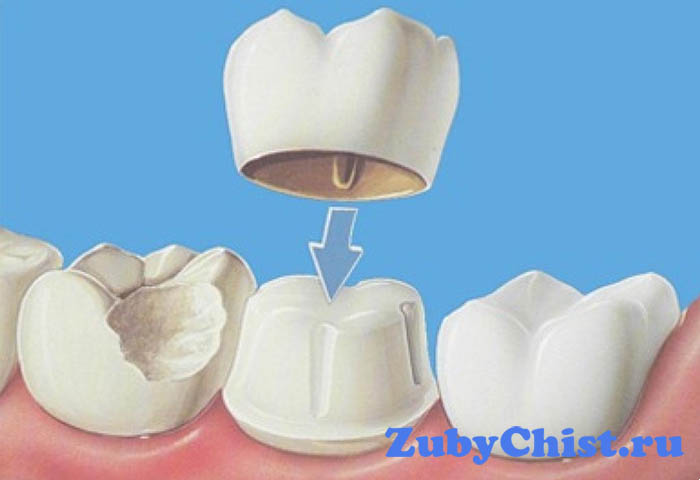 Зубная коронка