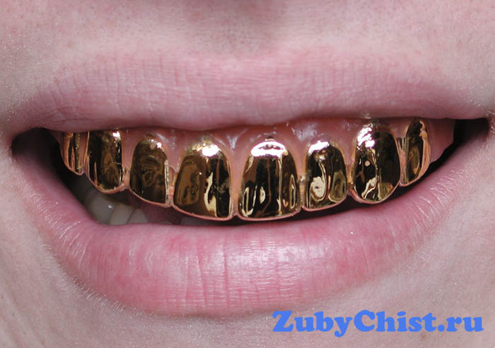 Зубные коронки - золотые зубы