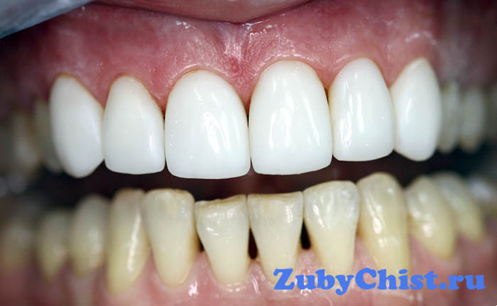 Виниры и обычные зубы