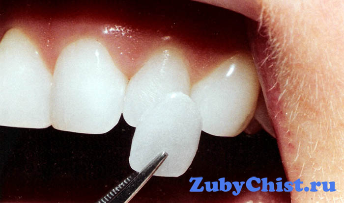 Накладка на зуб