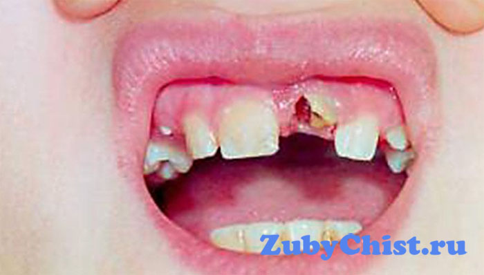 Травматический некроз челюсти