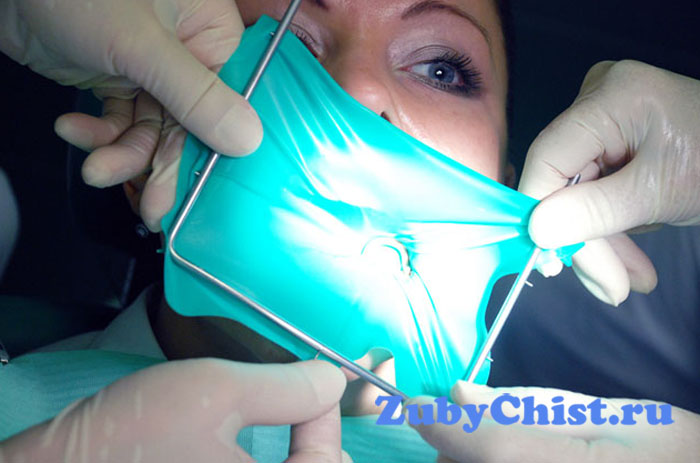 Удаление пульпы зуба