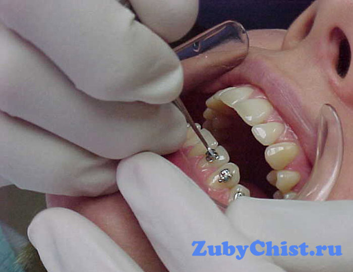 Установка брекетов