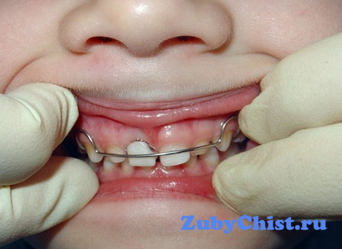 Установка пластины детям