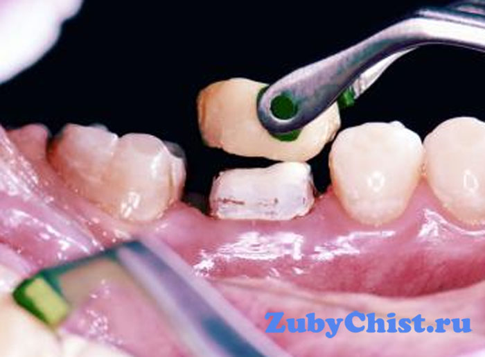 Установка коронки на зуб