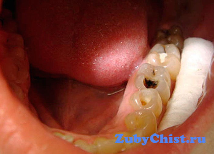 Фиброзный пульпит