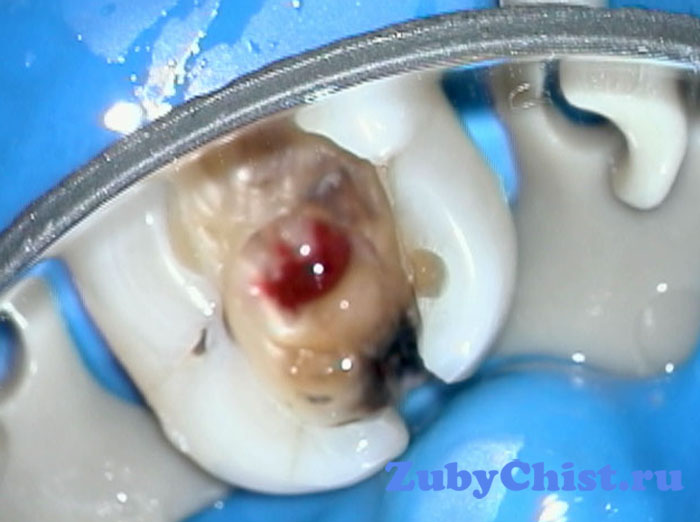 Хронический пульпит зуба в стадии обострения.