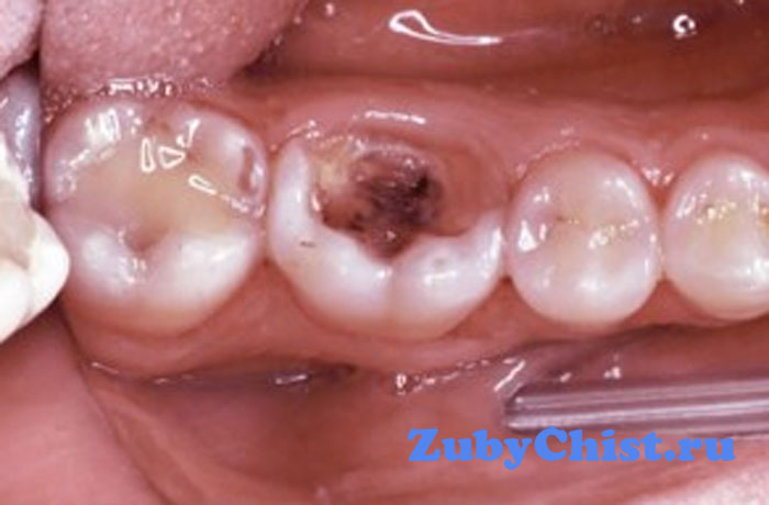 Хронический ярко выраженный пульпит