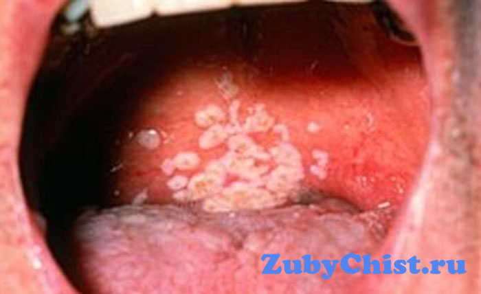 Хронический стоматит