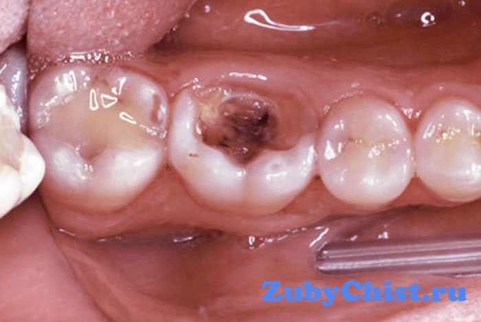 Хронический пульпит