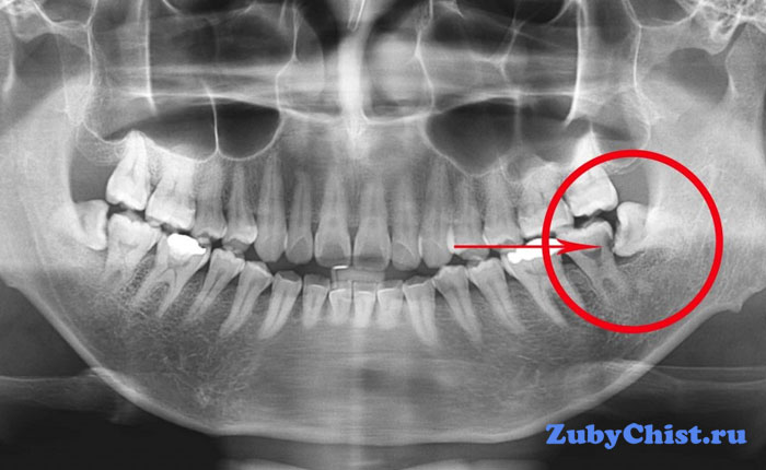 Аномальный наклон