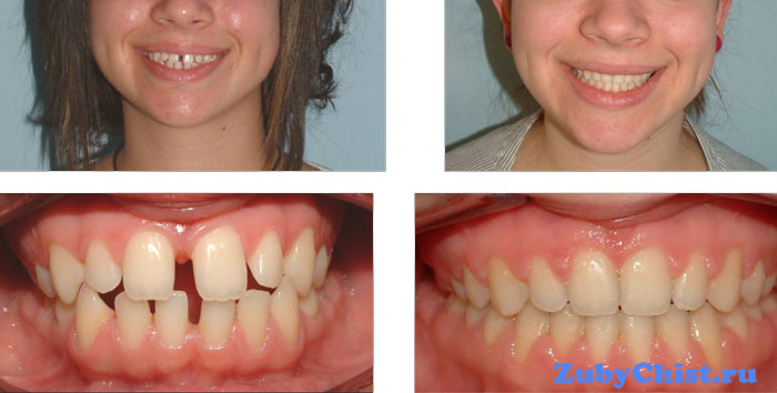 Выравнивание зубов брекетами