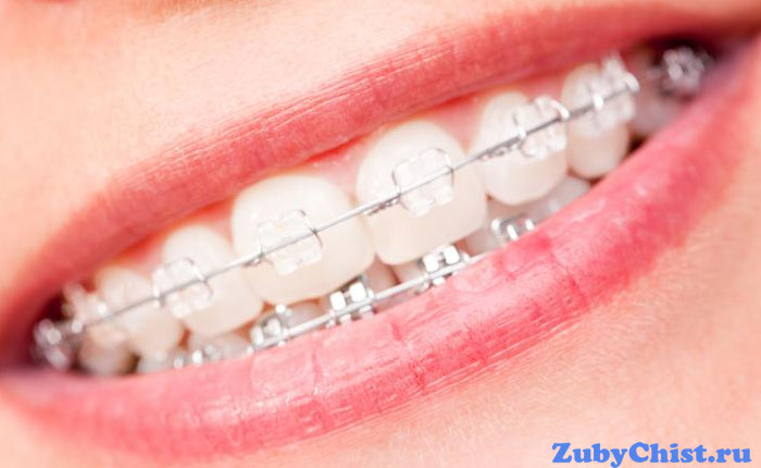 Брекеты на зубах