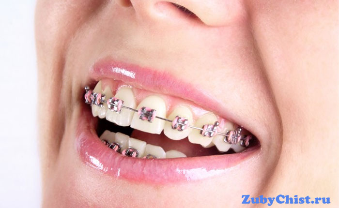 Брекеты
