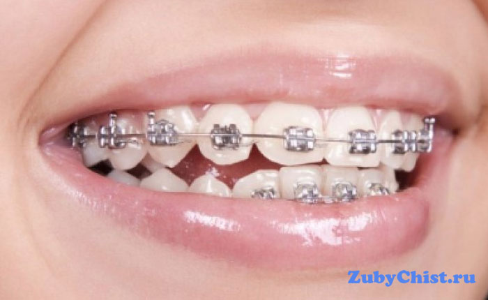 Брекеты