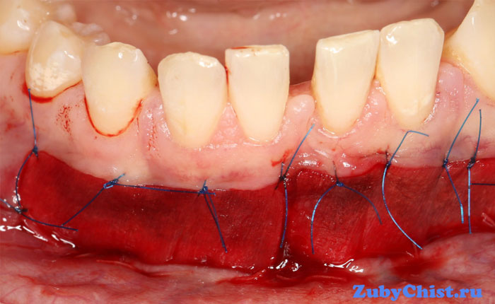 Вестибулопластика