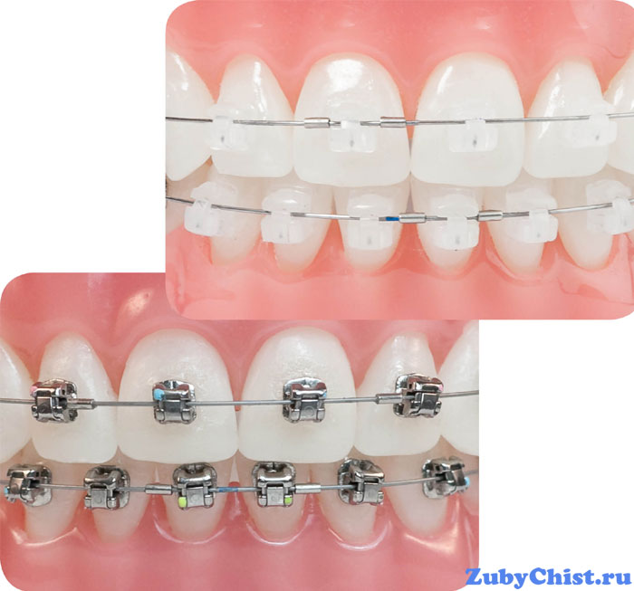 виды-брекетов