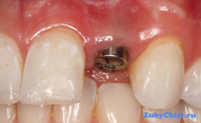 Внедренный имплант