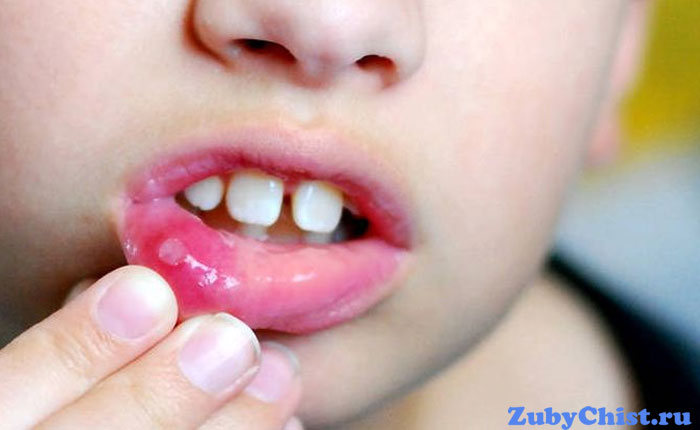 Герпесный стаматит