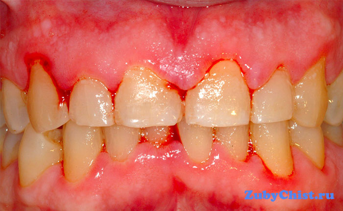 Воспаление десен