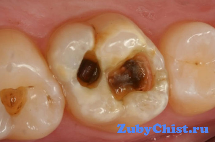 Глубокий кариес