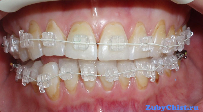 Желтоватая эмаль