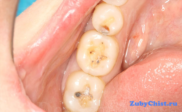 Пораженные зубы