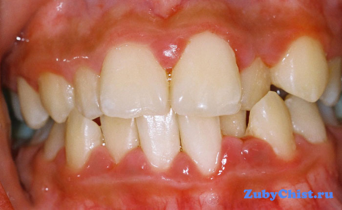 Катаральный