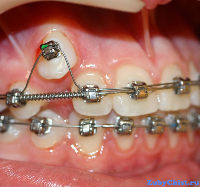 Металлические