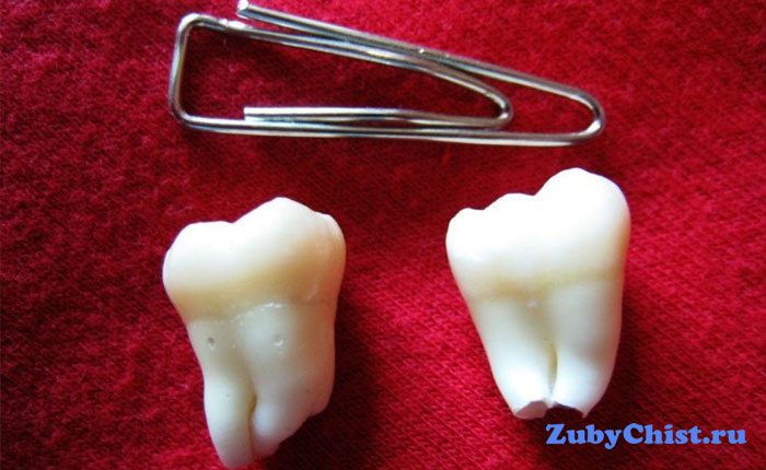 Вырванные зубы