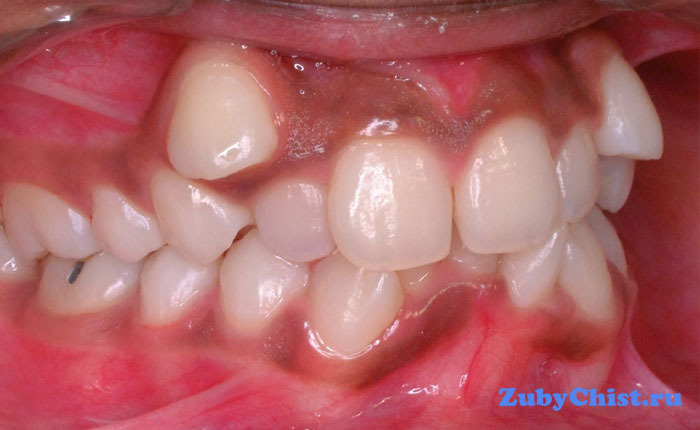 Неправильный прикус