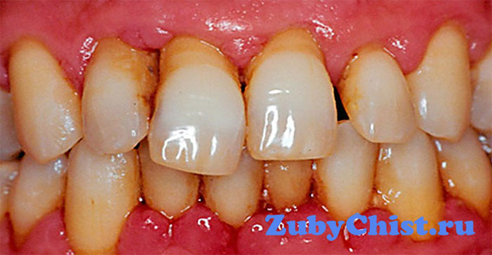 Пародонтит