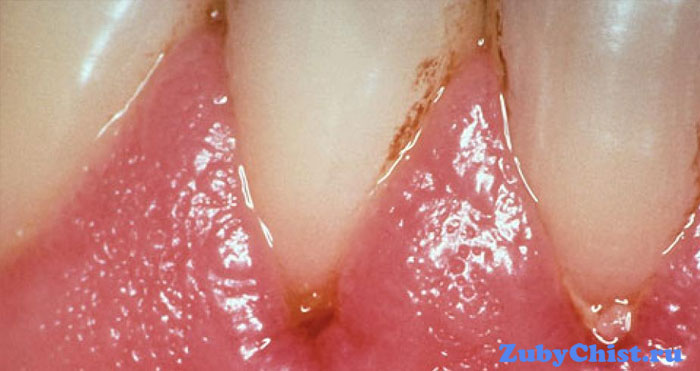 Пораженные десна