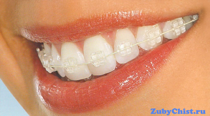 Прозрачные брекеты